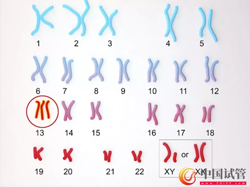 唐氏综合征21号异常染色体引发的危害(图1) 唐氏综合征21号异常染色体引发的危害(图1)
