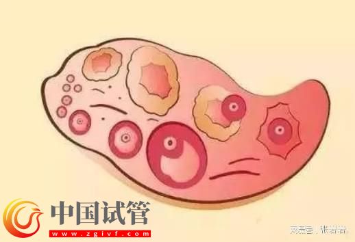 卵巢早衰卵泡不发育怎么办?卵巢早衰可以借卵试管生孩子吗?(图7) 卵巢早衰卵泡不发育怎么办?卵巢早衰可以借卵试管生孩子吗?(图7)