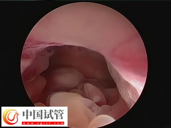 子宫内膜息肉会不会影响试管婴儿(图1) 子宫内膜息肉会不会影响试管婴儿(图1)