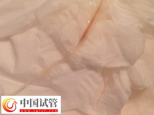 试管婴儿囊胚移植10天只有浅粉有机会,时间不一也正常(图1) 试管婴儿囊胚移植10天只有浅粉有机会,时间不一也正常(图1)