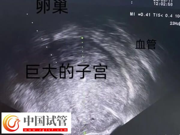 为什么41岁女人做试管婴儿会失败?背后真相大揭秘(图2) 为什么41岁女人做试管婴儿会失败?背后真相大揭秘(图2)