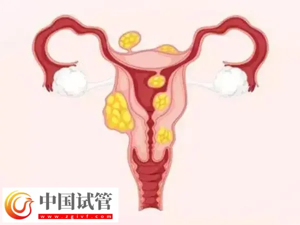 子宫肌瘤做试管婴儿注意事项有哪些(图1) 子宫肌瘤做试管婴儿注意事项有哪些(图1)