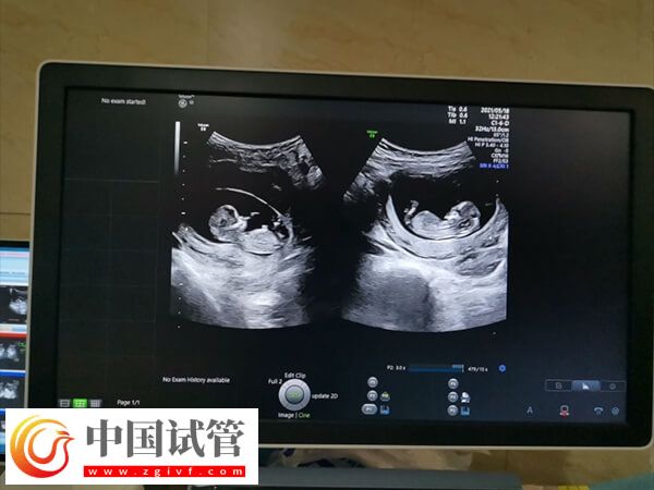 10个人做试管几个能成功(图2) 10个人做试管几个能成功(图2)