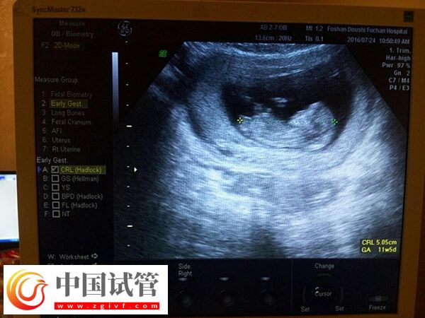 试管移植14天后做什么检查(图1) 试管移植14天后做什么检查(图1)