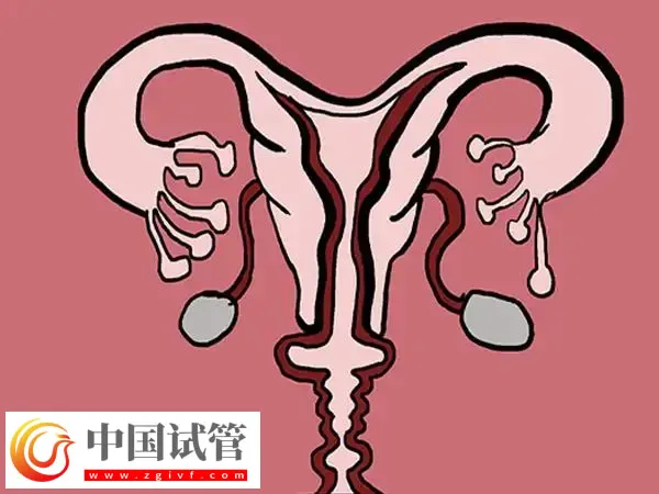 输卵管堵塞做试管婴儿成功率高不高(图1) 输卵管堵塞做试管婴儿成功率高不高(图1)