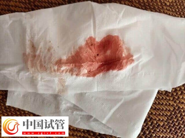 试管移植后不规则出血怎么办么办(图1) 试管移植后不规则出血怎么办(图1)