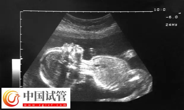 助孕4月后出血原因(图4) 助孕4月后出血原因(图4)