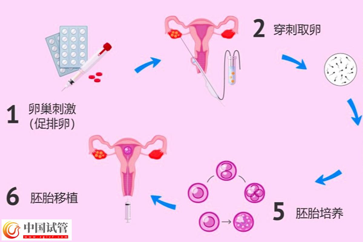 试管婴儿从取卵到胚胎移植的完整流程(图2) 试管婴儿从取卵到胚胎移植的完整流程(图2)