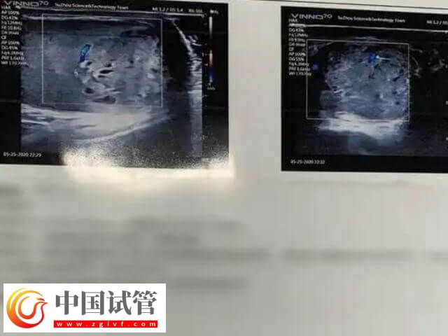 胚胎移植前如何调理内膜(图1) 胚胎移植前如何调理内膜(图1)