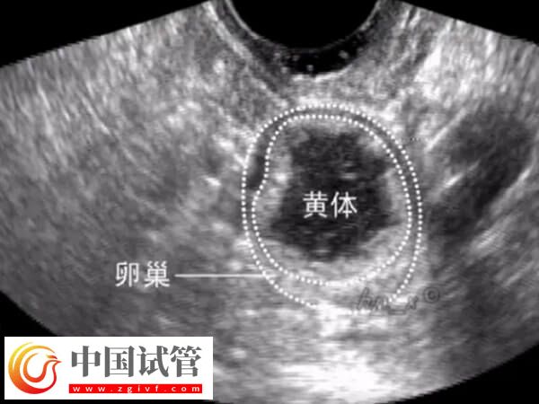 取卵后还有黄体残留怎么办(图1) 取卵后还有黄体残留怎么办(图1)