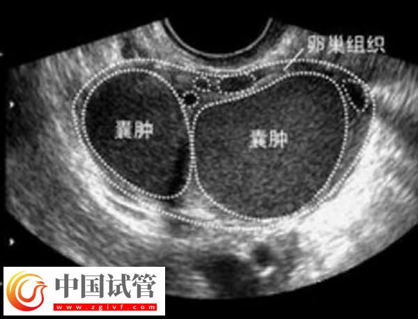 试管巧囊4cm影响着床(图1) 试管巧囊4cm影响着床(图1)