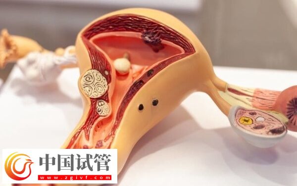 试管巧囊4cm影响着床(图2) 试管巧囊4cm影响着床(图2)