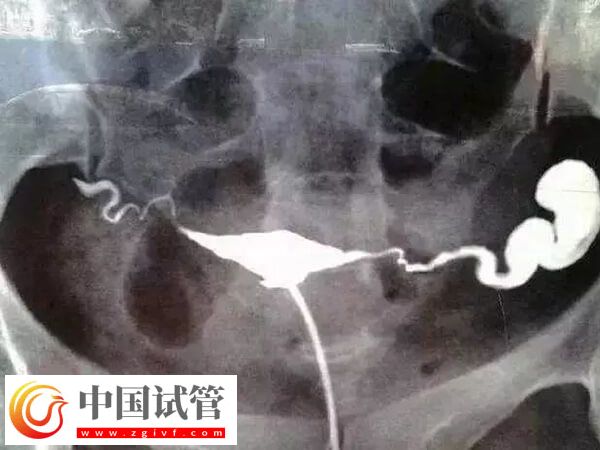 做试管输卵管积水有没有影响(图1) 做试管输卵管积水有没有影响(图1)