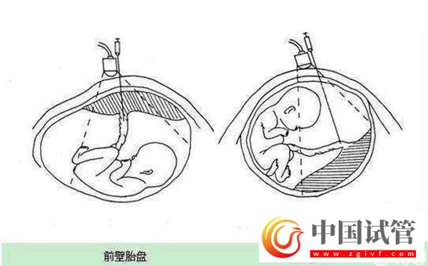 1分钟了解胎盘前壁和后壁的3大区别,为孕期做好准备(图1) 1分钟了解胎盘前壁和后壁的3大区别,为孕期做好准备(图1)