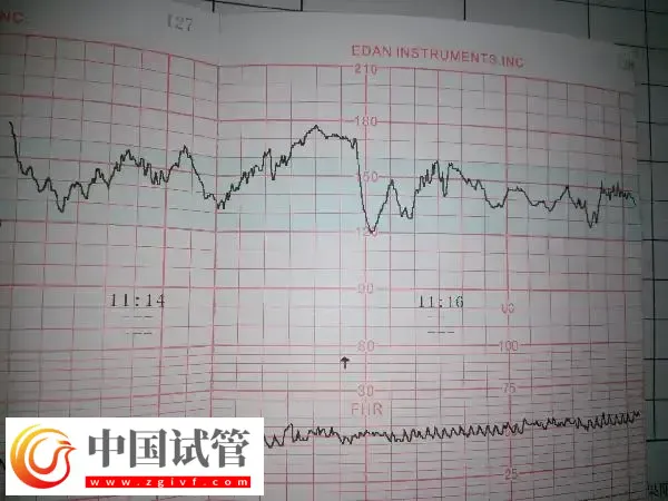 试管胚胎移植做二超能不能转产科(图2) 试管胚胎移植做二超能不能转产科(图2)