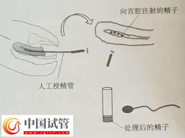 吉安市妇幼保健院人工授精的治疗流程是怎么样的?(图3) 吉安市妇幼保健院人工授精的治疗流程是怎么样的?(图3)