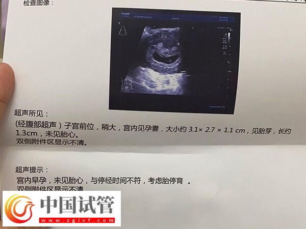 试管胎停育的前兆反应有哪些(图1) 试管胎停育的前兆反应有哪些(图1)