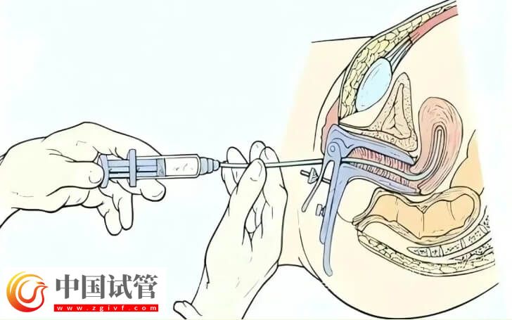 自体富血小板血浆PRP宫腔灌注过程安全无痛无创吗?(图1) 自体富血小板血浆PRP宫腔灌注过程安全无痛无创吗?(图1)