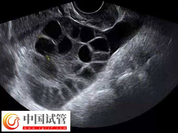 试管取卵对女性的卵泡也有要求,小于18mm一般还未发育成熟(图1) 试管取卵对女性的卵泡也有要求,小于18mm一般还未发育成熟(图1)