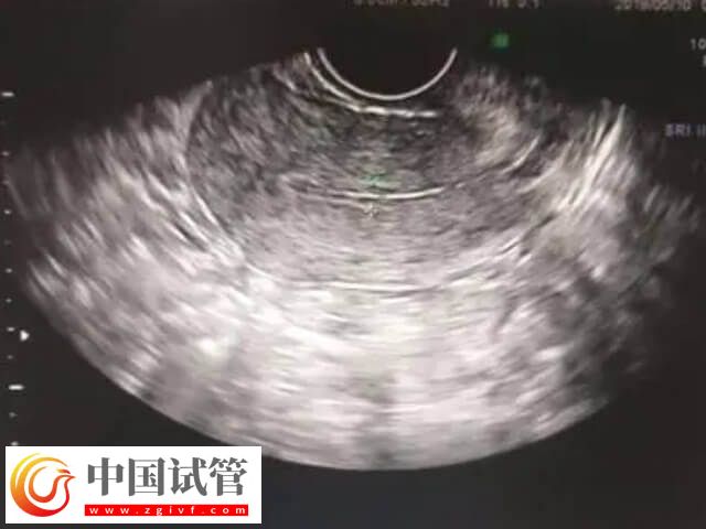 amh低于0.06还有没有卵(图2) amh低于0.06还有没有卵(图2)