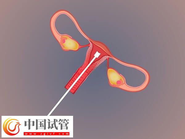 不经中介去泰国做试管要怎么做(图2) 不经中介去泰国做试管要怎么做(图1)