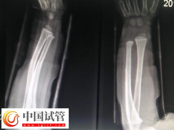骨折愈合一年可不可以做试管(图2) 骨折愈合一年可不可以做试管(图2)