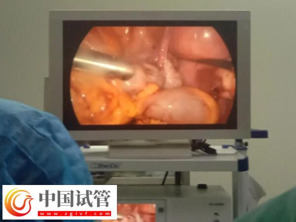 腹腔镜子宫切除手术怎么做(图5) 腹腔镜子宫切除手术怎么做(图5)