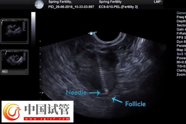 做试管婴儿取卵后有腹水怎么办(图1) 做试管婴儿取卵后有腹水怎么办(图1)