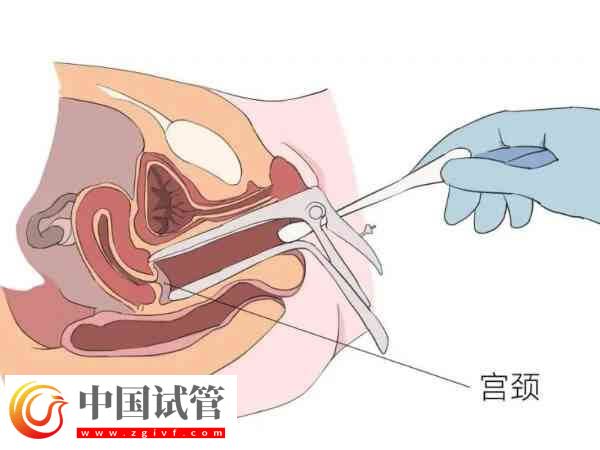 宫腔粘连是怎么引起的(图1) 宫腔粘连是怎么引起的(图1)