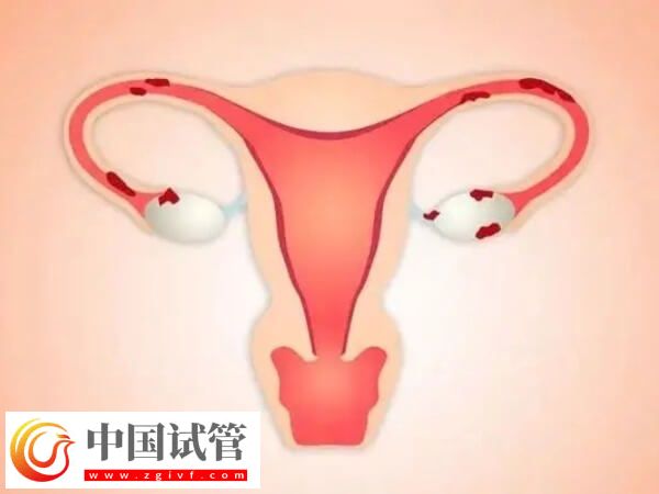 腔粘连不治会有什么后果(图1) 腔粘连不治会有什么后果(图1)