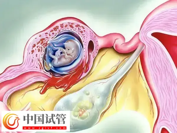 导致女性出现宫外孕的原因有哪些(图1) 导致女性出现宫外孕的原因有哪些(图1)