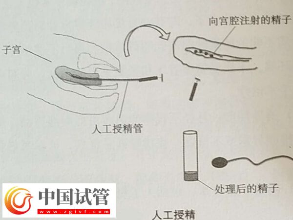 沧州人工授精多少钱一次?检查、促排卵要花多少?(图1) 沧州人工授精多少钱一次?检查、促排卵要花多少?(图1)