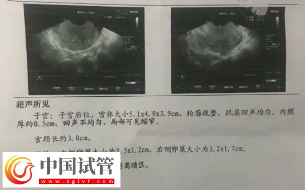 试管移植前内膜下降怎么回事(图2) 试管移植前内膜下降怎么回事(图2)