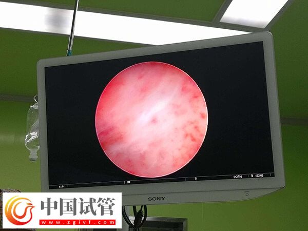 试管移植前内膜下降怎么回事(图1) 试管移植前内膜下降怎么回事(图1)